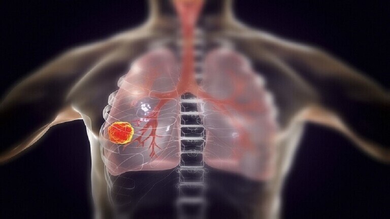 دام برس : دام برس | ثلاثة أدوية شائعة تمنع الإصابة بسرطان الرئة