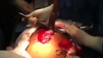 دام برس : دام برس | بالفيديو من البرازيل.. استخراج سمكة حية ظلت تنمو داخل أمعاء رجل