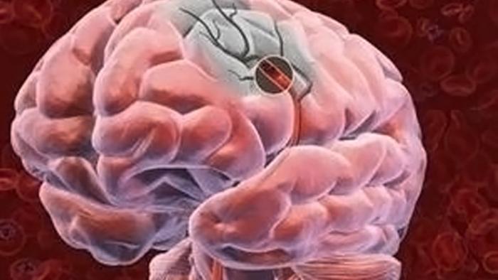 دام برس : دام برس | العلماء يثبتون تأثير المشروبات الغازية في تطور سرطان الدماغ