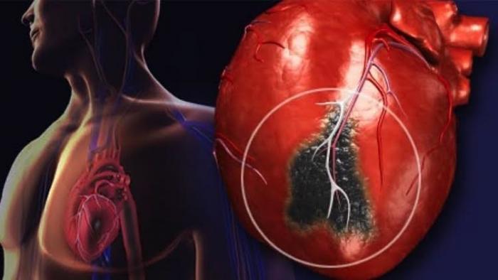 دام برس : نصف النوبات القلبية تحدث فجأة