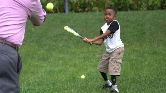 دام برس : دام برس | أول طفل في العالم خضع لعملية زرع يدين.. يلعب بيسبول
