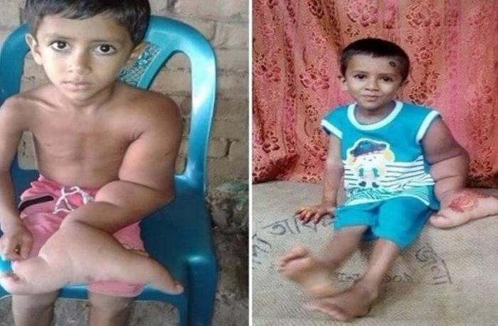 دام برس : دام برس | يد طفل تزن أكثر من 7 كيلوغرامات بسبب حالة نادرة