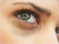 دام برس : فرط التصبغ تحت العين suborbital hyperpigmentation الهالات السوداء حول العين